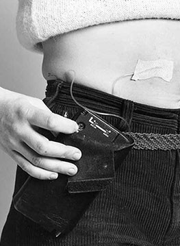 Patient with an insulin pump.
